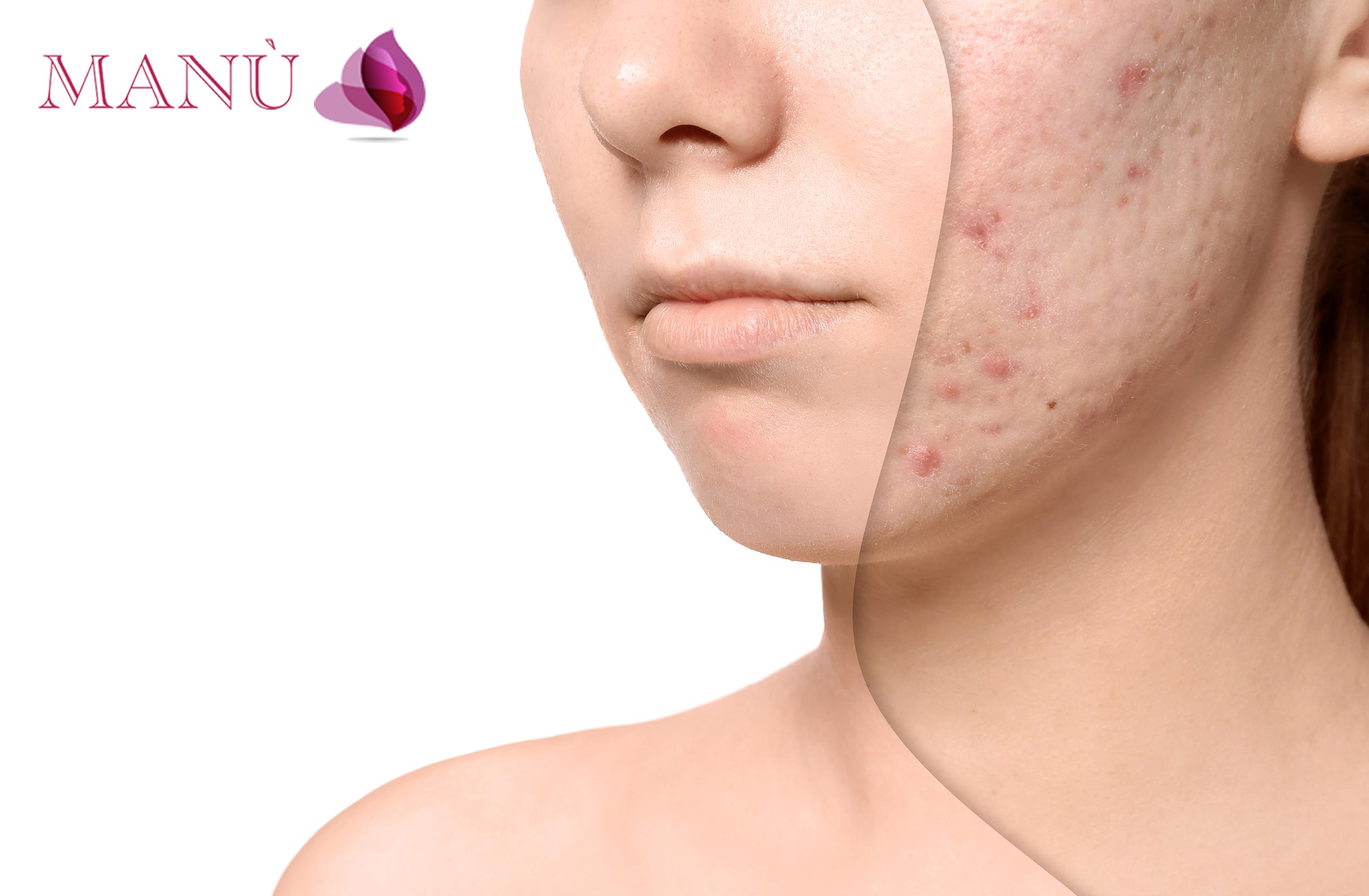 Cos’è l’acne? I trattamenti di Estetica Avanzata efficaci